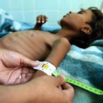 Children suffering from malnutrition in Yemen November 2018